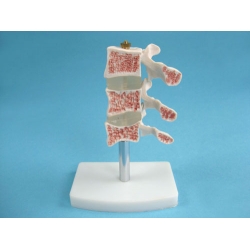 Medical Model of Spine Ailments