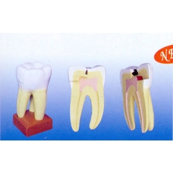 Three Caries Teeth of the Upper Jaw Model