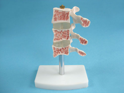 Medical Model of Spine Ailments