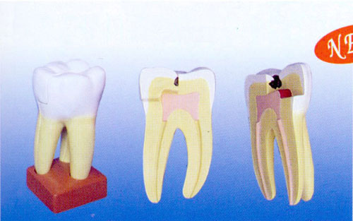 Three Caries Teeth of the Upper Jaw Model