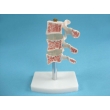 Medical Model of Spine Ailments