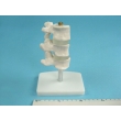 Medical Model of Spine Ailments